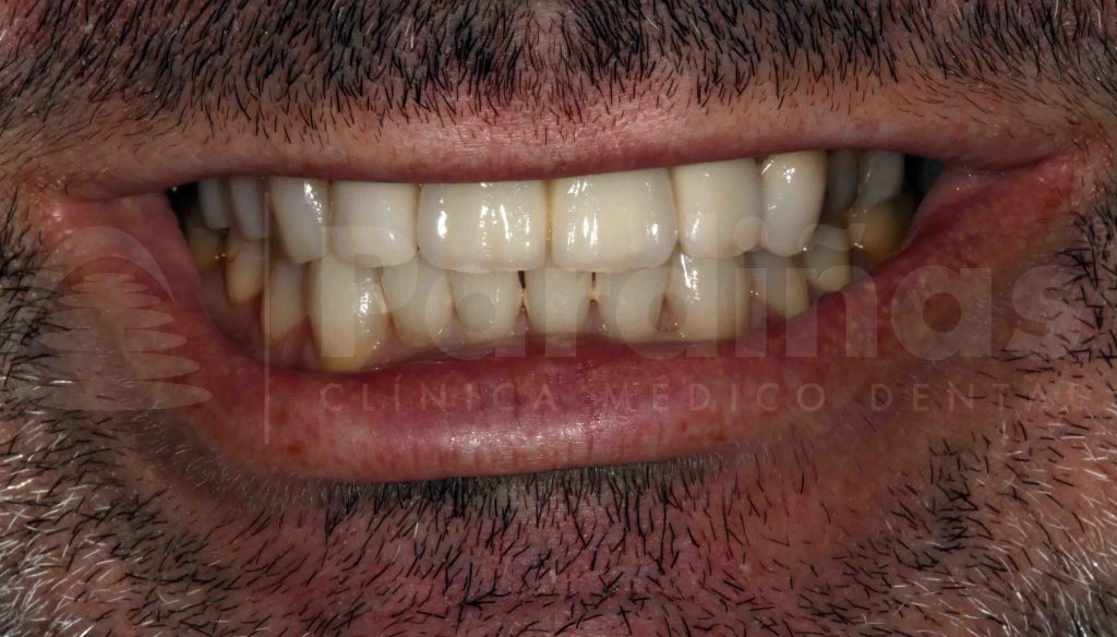 rehabilitacion protesis diente natural