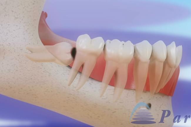 Pericoronaritis and wisdom teeth extraction