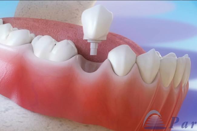 Inmediate dental implants post-extraction