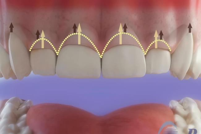 Gingivectomy, treatment of gummy smile
