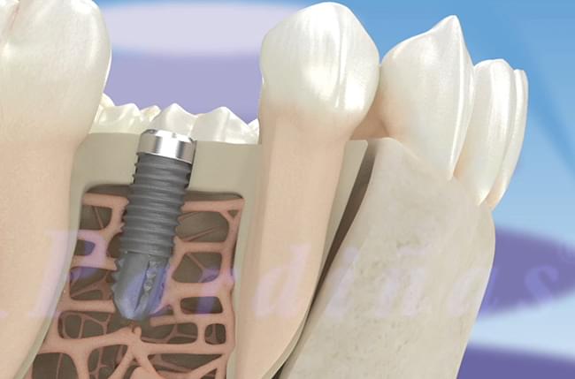La osteointegración es el proceso que realiza el cuerpo humano para crear una conexión directa y funcional entre el hueso y la superficie de los implantes dentales.