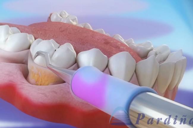 Treatment of periodontal disease: scaling and root planing 