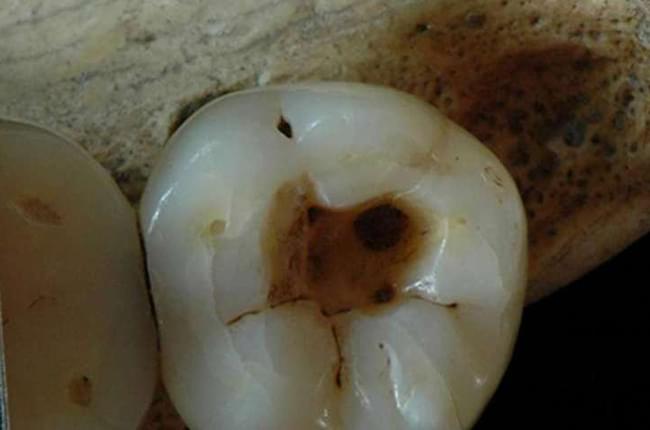 Localizado un diente con caries en la dentadura de un esqueleto con 14000 años de historia