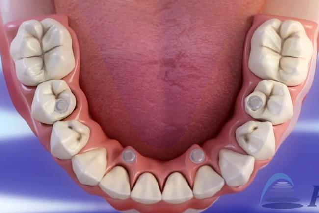 Implantes dentais, tratamiento All on four