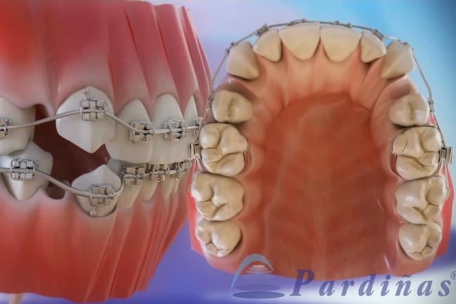 Dental extractions needed in orthodontic
