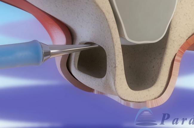 3D Videou about how the sinus lift procedure is performed in order to place dental implants