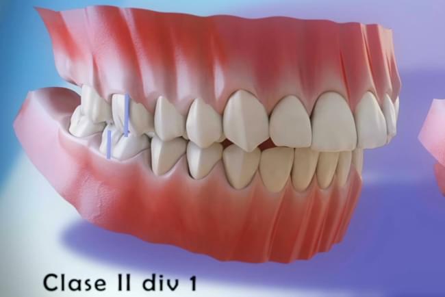 Vídeo 3d en el que se explica la maloclusión y se muestran los tipos de maloclusiones dentales