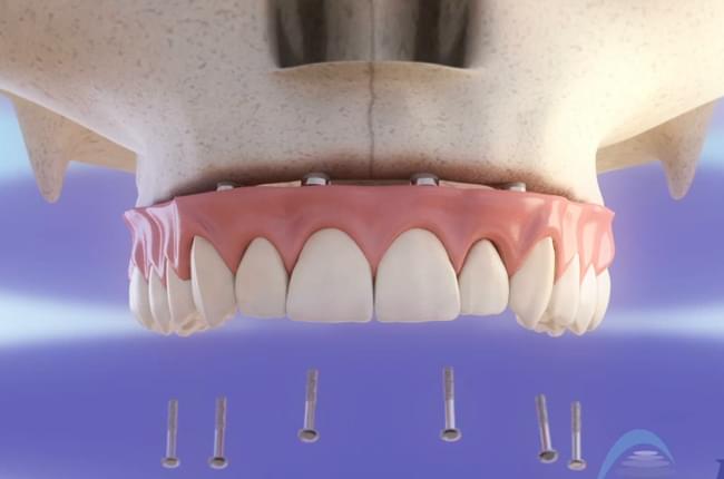 Video 3d sobre o tratamento de rehabilitación do maxilar superior realizado a partir de 6 implantes dentais