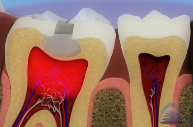 Vídeo 3D sobre a pulpite e sobre as causas e tratamentos da inflamación da polpa dental