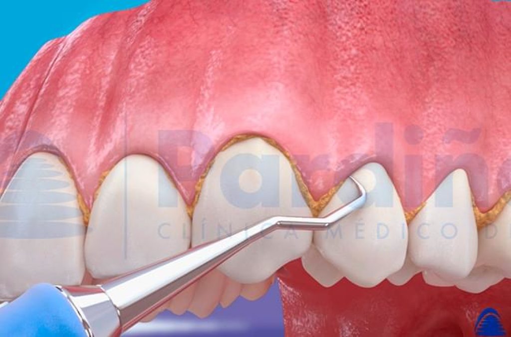 haz Th esfuerzo El sarro dental – Por qué se forma y cómo se elimina - Clínica Pardiñas