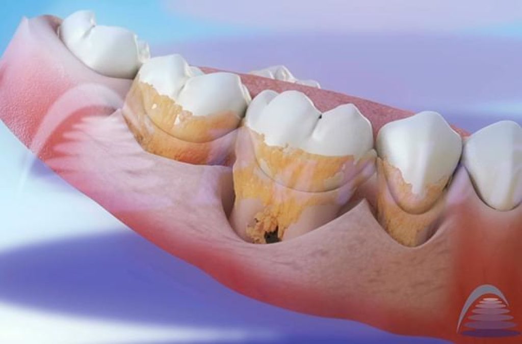 haz Th esfuerzo El sarro dental – Por qué se forma y cómo se elimina - Clínica Pardiñas
