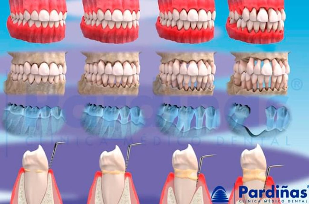 Dolor de mandíbula causa enfermedad periodontal