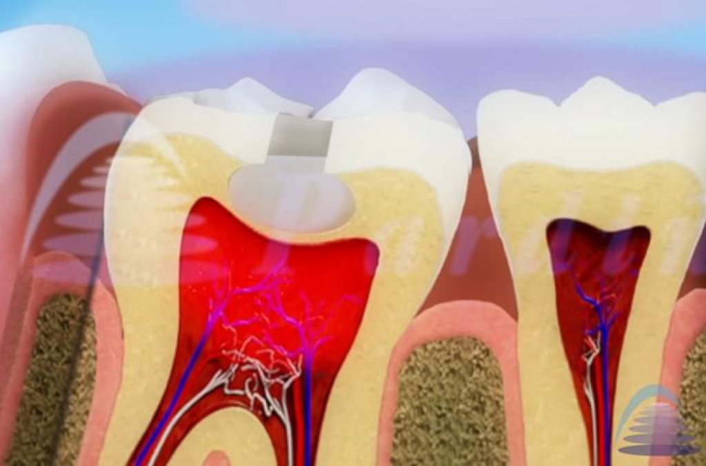 desgastes dentales causan pulpitis