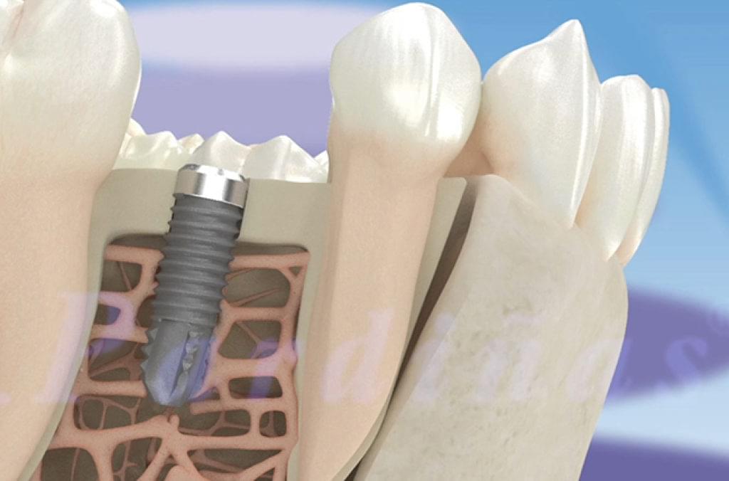 Teeth implants abroad